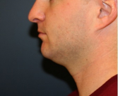 Feel Beautiful - Necklift and Chin Implant 203 - Before Photo